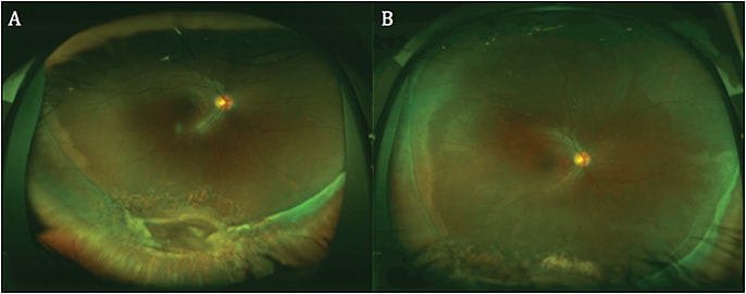 Figure 5. Ultrawidefield fundus images after scleral buckling with cryotherapy and laser shows resolution of retinal detachment (A) and gross reattachment of the retina (B).