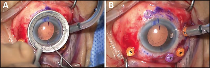Figure 1. Use a corneal marker to designate the meridians for externalization cannula placement precisely 180° apart (A). Center the marker around the limbus, not the pupil, which can be irregular as seen here. 23-gauge and 27-gauge set-up for a patient with retained lens fragments and posteriorly dislocated IOL complex (B). The slight sideways “puckering” of the 27-gauge cannulas in an inverse “S” shape often indicates good tunneling. Note the inferonasal placement of the infusion line in this left eye.