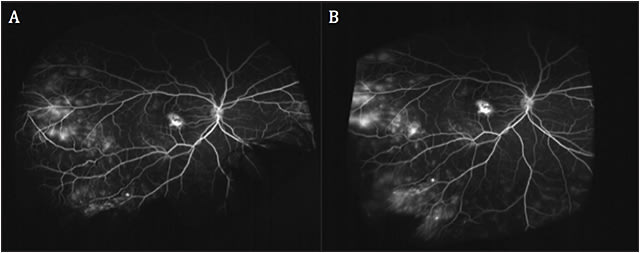 Figure 2. Widefield fundus fluorescein angiogram images of the same pediatric patient with Coats disease. Areas of hyperfluorescence in the macula and temporal periphery (A) increase over time in a later frame (B). This finding is consistent with vascular leakage typically associated with the exudative nature of Coats disease secondary to abnormal retinal vasculature.