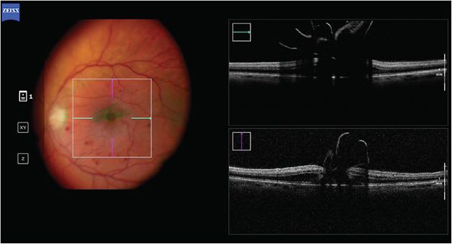 Figure 1. A 71-year-old female with a 680-&amp;#x3BC;m macular hole treated with an inner limiting membrane flap displaced on intraoperative optical coherence tomography. Image courtesy of Thomas Mendel, MD, and Alex Yuan, MD, Cole Eye Institute, Cleveland Clinic.