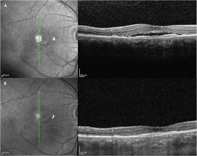 Figure 1. A patient with neovascular age-related macular degeneration (nAMD) treated with aflibercept every 4 to 6 weeks for their last 44 injections with persistent subretinal fluid (A). The same patient following 3 faricimab injections 6 weeks apart with complete resolution of subretinal fluid (B). Vision remained stable.