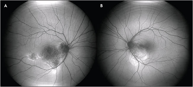 Figure 8. Bilateral central serous chorioretinopathy (A, right eye; B, left eye). Note the guttering phenomenon, with increased AF at the edges of chronic subretinal fluid, decreased AF in areas of retinal pigment epithelium atrophy, and punctate increased AF corresponding to subretinal precipitates.
