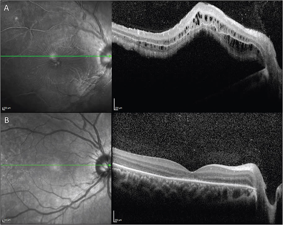 Figure 6. OCT images of preoperative macula-involving retinal detachment (A) that resolved after scleral buckling and cryotherapy (B). Postoperative OCT was obtained on postoperative day 3.