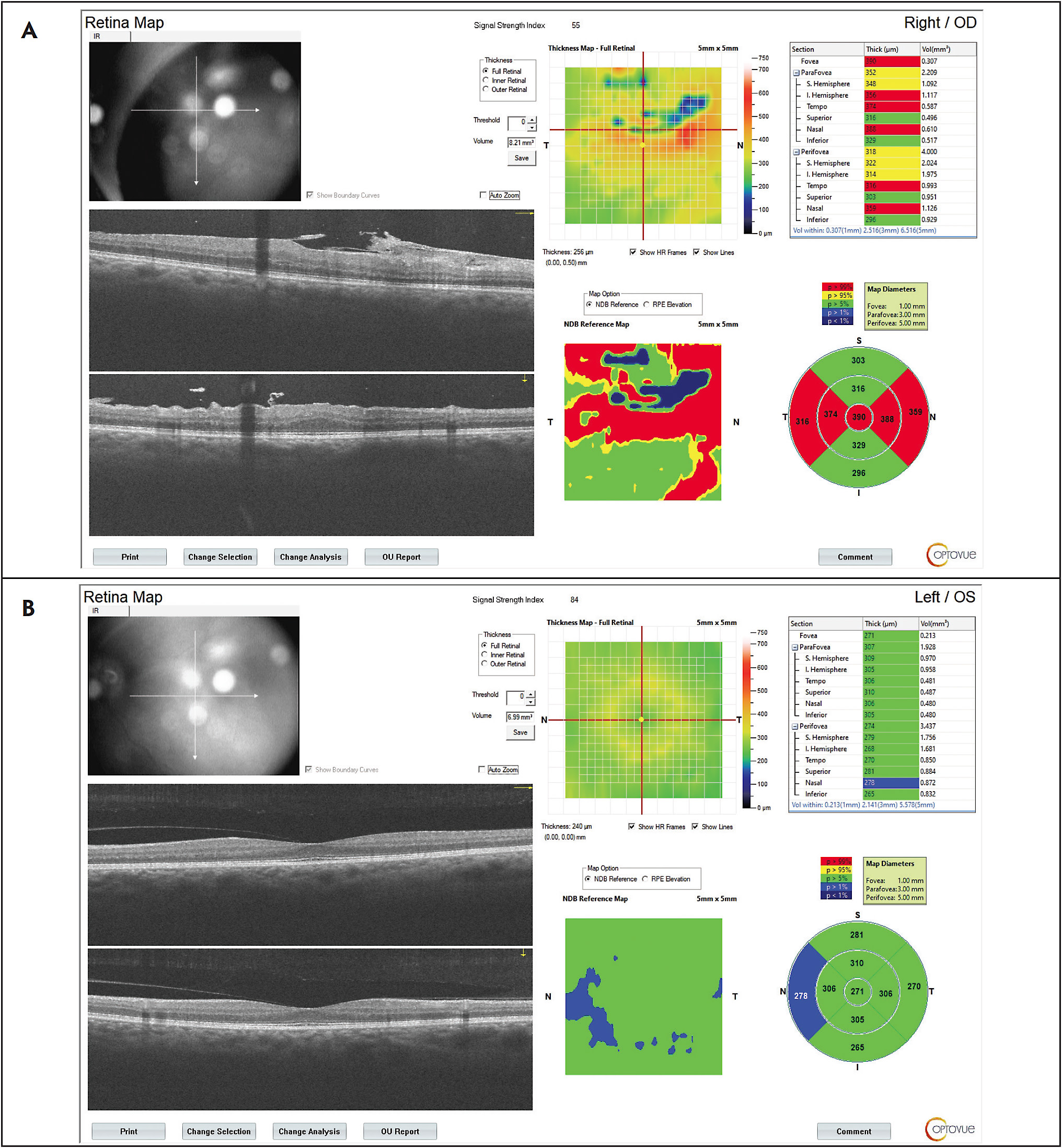Figure 2. Macular optical coherence tomography demonstrating epiretinal membrane in the right eye (A). The left eye is within normal limits (B).