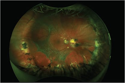 Figure 1. Fundus photograph of the right eye in a patient with a history of 5 retinal detachment repairs in the past. Fundus photograph shows a good scleral buckle indentation with prior 360&amp;#xB0; laser. Evident is a large inferior retinectomy with rolled edges and subretinal fluid extending into the macula. There are areas of traction and stretch holes nasally. Also evident is a subretinal band superior to the optic nerve emanating from a prior nasal retinotomy. There is a silicone oil fill.