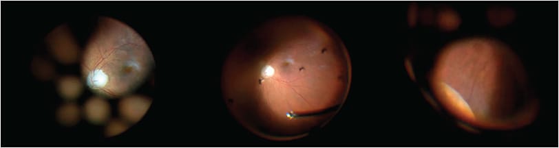 Figure 2. Wide-angle viewing systems allow for uninhibited visualization of the posterior segment and retinal periphery. These photos were taken during epiretinal membrane removal. From left to right, the posterior pole and holes in the backplate are visible; core vitrectomy is performed, followed by scleral depression.
IMAGE COURTESY OF JAY M. STEWART, MD, PROFESSOR OF OPHTHALMOLOGY, DEPARTMENT OF OPHTHALMOLOGY, UNIVERSITY OF CALIFORNIA SAN FRANCISCO.
