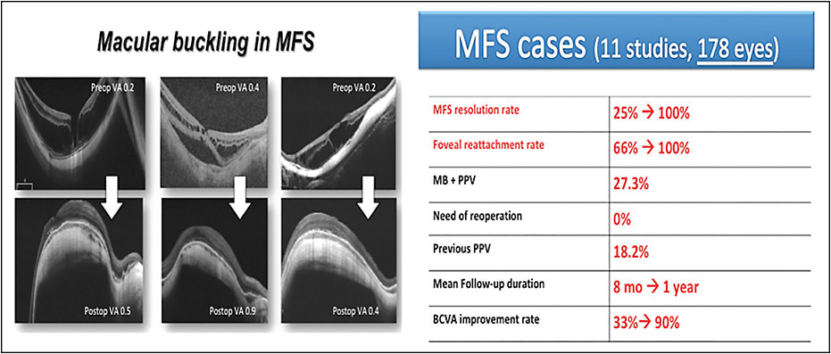 Figure 2. MB in MFS: pre- and postoperative OCT scans of 3 different cases of MFS treated with the MB technique (left). Anatomical and functional data including all of the published studies included in the review (right).