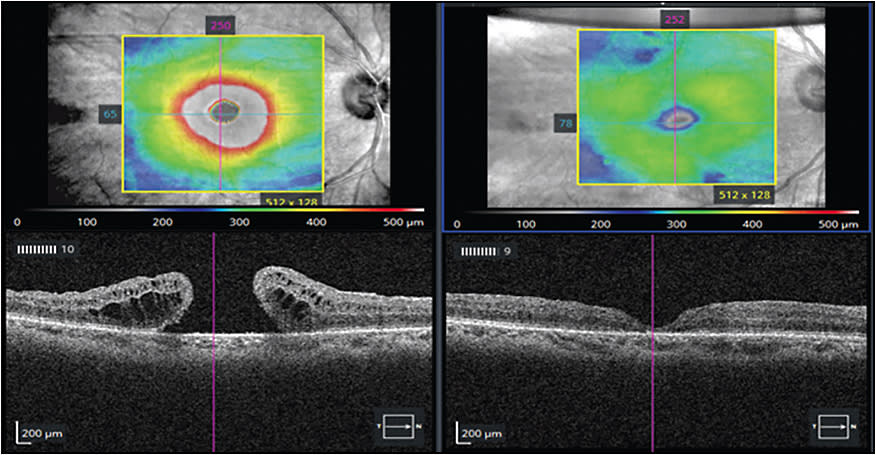 Figure 3. Preoperative optical coherence tomography with vision 20/100 and postoperative month 1 vision is 20/80. Image courtesy of Sumit Sharma, MD, Cole Eye Institute, Cleveland Clinic.