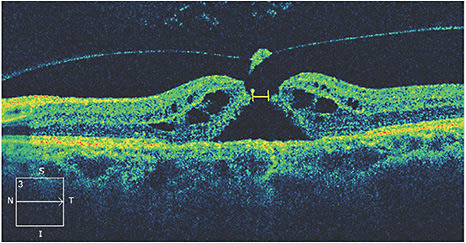 Figure 1. Based on minimum linear dimension, the OCT caliber function (yellow bracket) indicates a medium-size full-thickness macular hole. Overlying posterior vitreous detachment with operculum is also seen. Cystoid macular edema and slight lifting can be observed at the hole edges. These features are thought to predict a greater likelihood of closure following surgical repair.
Image courtesy of Christina Y. Weng, MD, MBA