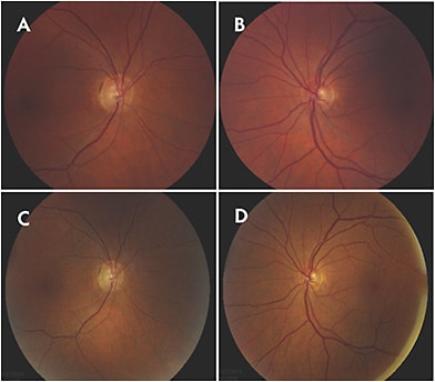 Figure 1. Fundus photography of the macula and optic nerve at initial presentation for the right (A) and left eyes (B). The right eye demonstrated granularity in the macular area with attenuation of the arteries with temporal pallor of the optic nerve. At final presentation 3 years later, the right eye showed progressive vascular attenuation with temporal pallor of the optic nerve (C); the left eye remained normal (D).