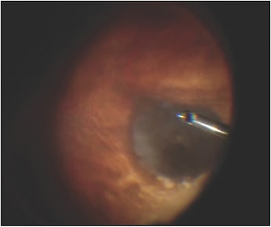 Figure 1. A large pigmented temporal mass with an exudative retinal detachment.