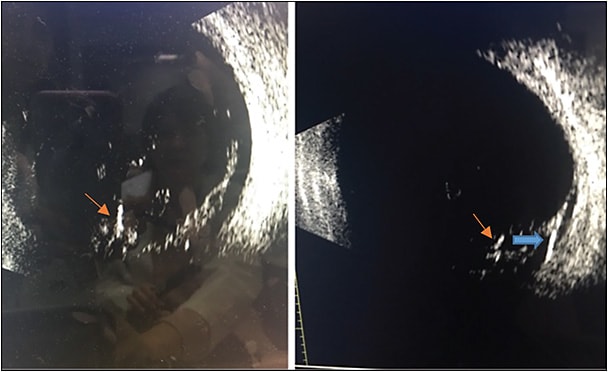 Figure 4. B-scan ultrasonography demonstrates intraocular foreign body (plastic; orange arrow) with focal retinal detachment (blue arrow).