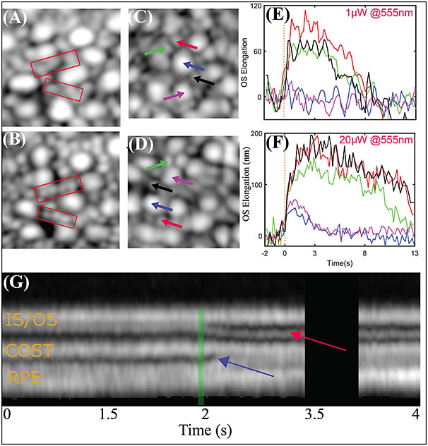 Figure 3. Images A and B are examples of simultaneously acquired adaptive optics (AO) scanning laser ophthalmoscopy (SLO) optical coherence tomography (OCT) retinal images at 6o temporal to the fovea.10 Rods are not as well resolved in the OCT en face projection (A) as they are in the SLO image (B). Images C and D show the OCT en face projections acquired 6° temporal to the fovea in 2 trials of different stimulus intensities, while E and F show plots of the corresponding elongation of select rods and cones in the field. In images C and E, the flash bleached 0.2% and 0.05% of L/M photopigment and rod pigment, respectively, while the brighter flash in images D and F bleached 4.0% and 1.0%, respectively. No cone elongation is visible in response to the dimmer flash in image E, whereas a clear rod response is visible. In response to the brighter flash in image F, both rods and cones elongate, with the elongation of rods having several times higher amplitude. Changes in the axial morphology of cones with 70% photopigment bleaching are shown in image G. The red arrow shows the appearance of an extra band between inner segment/outer segment and cone OS tip was observed in most of the cones. The blue arrow indicates changes observed in the retinal pigment epithelium and subretinal space. Figure adapted with permission from The Optical Society.8,10 IS/OS, inner-segment/outer-segment; COST, cone OS tip; RPE, retinal pigment epithelium. Average of 50 motion-corrected cone mosaics at the fovea from the adaptive optics (AO) scanning laser ophthalmoscopy (SLO) channel (A) and AO-optical coherence tomography (OCT) channel (B). Average of 50 motion-corrected cone mosaics at 6° temporal retina from the SLO channel (C) and OCT channel (D).