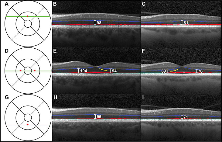 Figure. Frontotemporal degeneration with outer retina thinning. OCT images from a control and FTD patient showing outer nuclear layer thinning. The ETDRS grid is shown in A, D, and G with the green line indicating the location of the OCT scan and the red asterisk indicating the location of a point measurement. The control (B, E, H) is a 61-year-old white female. The patient (C, F, I) is a 60-year-old white female clinically diagnosed with the behavioral variant of FTD. This FTD patient has presumed tauopathy because she has a MAPT E10+16 C>T mutation. The Iowa Reference Algorithm segmentation lines for the ONL are shown in red and blue. Yellow lines indicate locations of hyper-reflectivity related to Henle’s fiber layer.26 Spectralis (Heidelberg Engineering) caliper point measurements (μm) of ONL thickness are labeled in white. Reprinted with permission from Wolters Kluwer.25