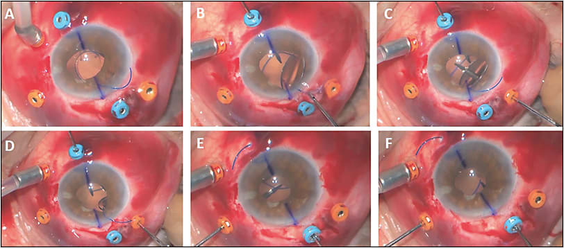 Figure 3. Inject the new intraocular lens with the leading haptic below the iris and the trailing haptic residing outside the corneal wound (A). Manipulate the external trailing haptic with forceps to bring the leading haptic into view so that it can be grasped anywhere with retina forceps (B). Use a hand-to-hand technique to then grasp the haptic with another pair of retina forceps through the vitrectomy port (C). This will allow the externalization forceps to reposition to the haptic tip and externalize the inferior haptic (D). The same hand-to-hand technique is then used for the superior haptic by passing the trailing haptic to forceps through the vitrectomy port (E). While stabilizing the haptic with one hand, the externalizing retina forceps in the other hand can grab the distal tip of the superior haptic and externalize it (F).