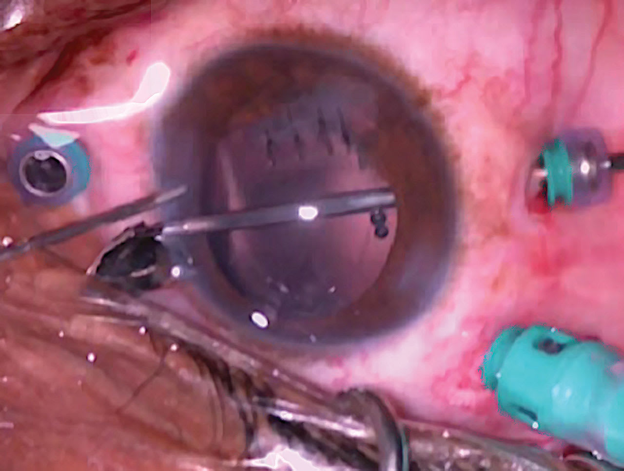 <p><strong>Figure 3. </strong>Using an instrument through the inferior port, the IOFB is pushed through a corneal incision.</p>