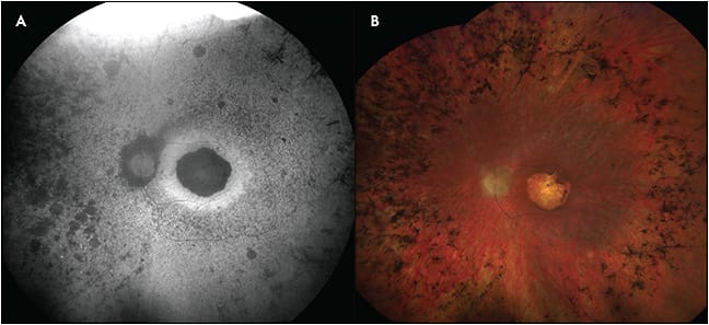 Figure 6. Progressive cone-rod dystrophy shown with fundus autofluorescence (A) and color fundus (B) photos. Prominent features of the fundus autofluorescence image include decreased autofluorescence corresponding to central atrophy, surrounded by a ring of increased autofluorescence, and patchy areas of decreased autofluorescence in regions of atrophy and pigment clumping.