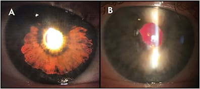Figure 2. Retroillumination reveals a visually significant iris defect in a patient with disabling glare (A). The iris defect is alleviated by a suture-fixated CFIP behind the native iris (B). Photos courtesy of VEO Ophthalmics