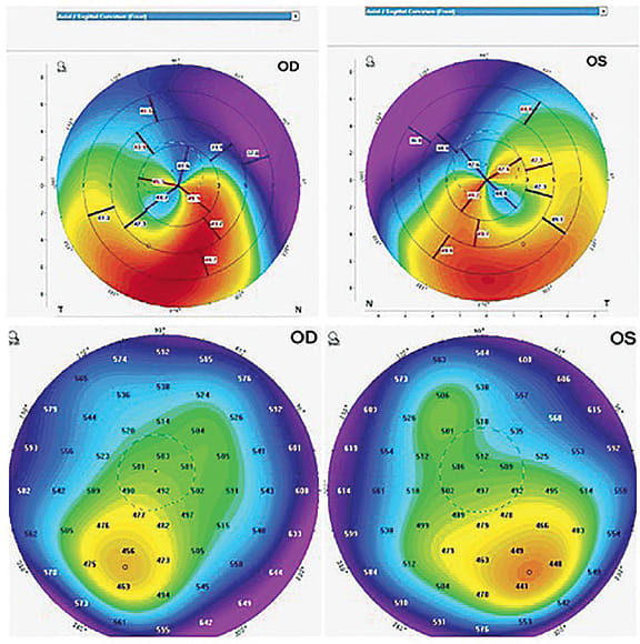 Figure 3. “Crab claw” or “kissing doves” pattern (top right) versus true corneal thickness per pachymetry near the limbus (left side).