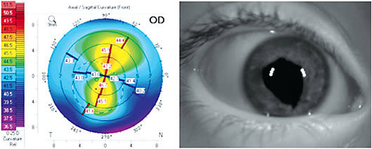 Figure 1. The figure on the left shows the corneal topography, revealing asymmetric astigmatism in the right eye with K values of 43.00/47.00 @ 77.3. The figure on the right is a slit lamp image of the right eye with an inferior scar and dyscoria.