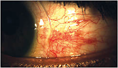 Figure 2. Attempt to avoid the pinguecula with a landing zone notch was unsuccessful.