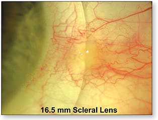 Figure 2. A 16.5mm scleral lens positioned over an elevated pinguecula.