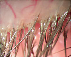 Figure 1. Cylindrical dandruff typical of Demodex over-population. Image courtesy of Luis Rojas, OD.