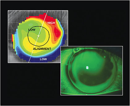 Figure 2. The fluorescein pattern of the right eye matches the elevation map.