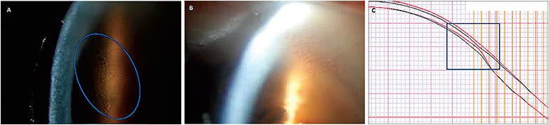 Figure 3. Limbal edema as a result of crowding/touch along the limbal region—contributing to lens suction and difficult removal (A). Edema was resolved (B) after increasing the limbal clearance (C).
Image courtesy of Karen G. Carrasquillo, OD, PhD