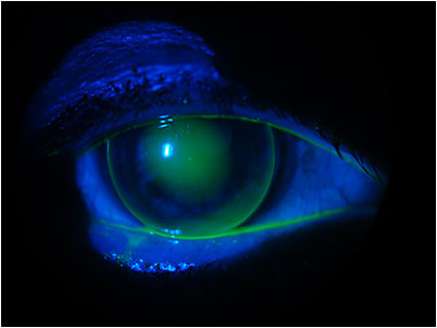 Figure 5. Fluorescein pattern of the lens refit, 2017.