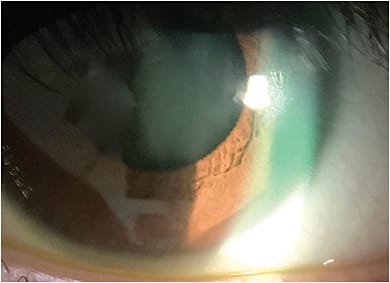 Figure 2. Scleral lenses are a viable management option for dry eye patients.