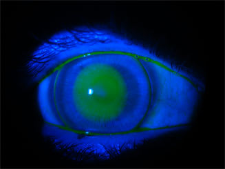 Figure 4. The pattern of the new fit; notice a small leukoma at the apex.