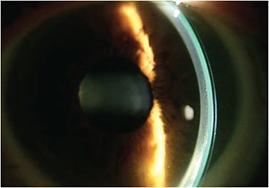 Figure 3. A scleral lens on a normal cornea showing adequate central corneal clearance with fluorescein.
Photo courtesy of Tom Arnold, OD