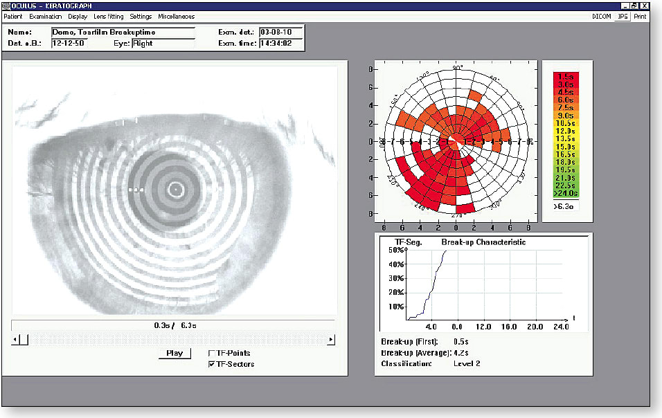 Figure 1. Abnormal non-invasive tear breakup with a more than 50% area of breakup with a steep slope of the breakup curve. The first breakup occurs at 0.5 seconds, and average breakup is at 4.2 seconds.
