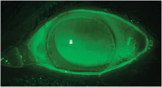 Figure 11. Corneal edema after accidentally wearing a scleral lens overnight. Note the furrow staining in the periphery and epithelial blebs and microcysts scattered throughout the cornea.
Image courtesy of Karen G. Carrasquillo, OD, PhD