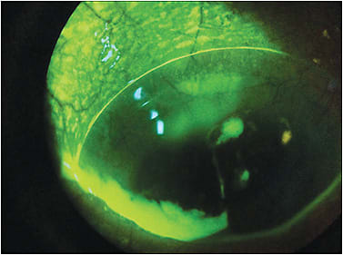 Figure 4. Sodium fluorescein dye highlighting mucus found on the ocular surface.
Courtesy of Javeria Azhar, OD, Midwestern College of Optometry