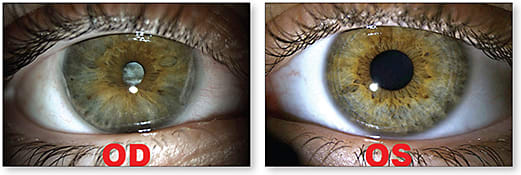 Figure 1. Teenage female patient with a history of ocular toxocariasis at age 4, OD and OS shown. Note the anisocoria as well as the leukocoria and iris heterochromia, OD, about which she was self-conscious.