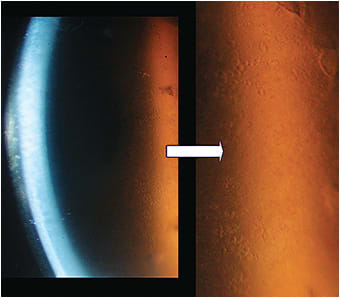 Figure 2. Manifestation of microcystic epithelial corneal edema and reduced BCVA after an acute increase in IOP. BCVA went down from 20/25 to 20/50. IOP went up from a range of 17 mmHg to 32 mmHg. This patient has neurotrophic keratopathy and glaucoma and had been a successful scleral lens patient for five years, with the goal to support the ocular surface. Corneal edema resolved once the IOP in the left eye was properly managed. There was no need to revise the fit.
Image courtesy of Karen G. Carrasquillo, OD, PhD