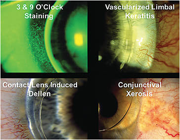 Figure 1. Most of the ocular complications that take place with corneal GP lenses occur outside of the boundaries of the contact lens.