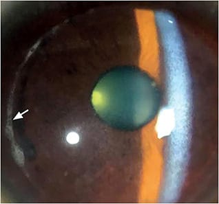 Figure 1. Biomicroscopy of Thiel-Behnke dystrophy in which diagnosis was confirmed on a histopathological basis of absence of rod-shaped subcellular deposits. This patient had a lamellar keratoplasty 27 years earlier; the arrow indicates the perimeter of the transplant. The lack of a distinctive honeycomb pattern may make accurate diagnosis uncertain at the clinical level.