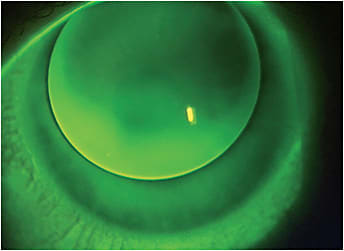 Figure 1. Superior decentration caused by upper lid attachment to a high-minus lens edge.