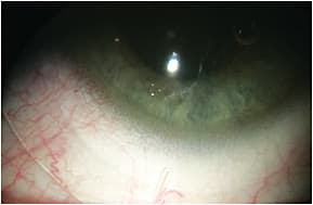 Figure 7. SL laser marked in the steeper meridian.