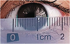 Figure 1. Handheld ruler used to measure HVID (> 12mm). Photo captured of the measurement and then zoomed in to accurately measure.