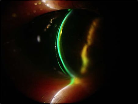 Figure 6. Slit lamp cross-section view of the new contact lens.