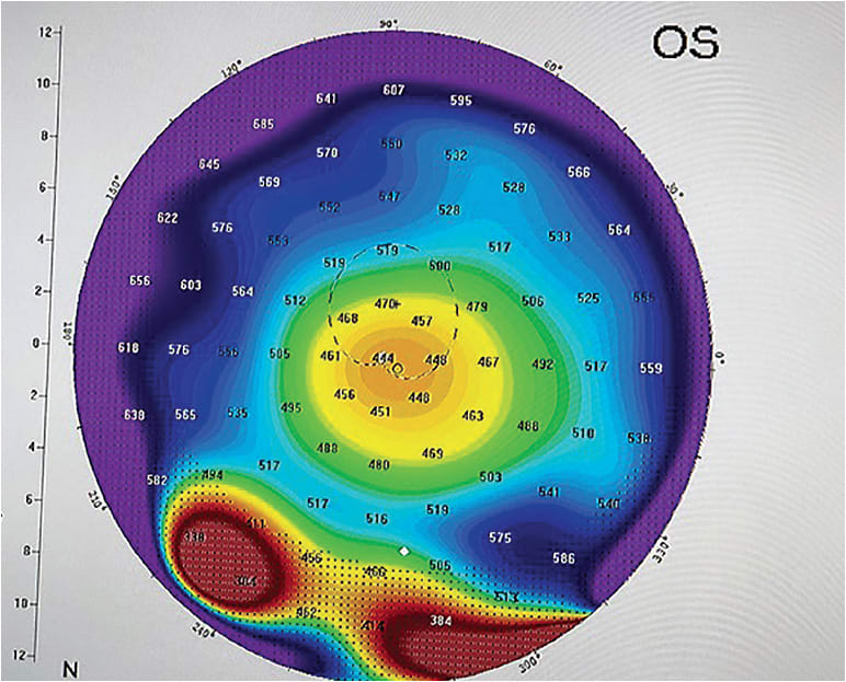 Figure 1. True PMD with a band of corneal thinning near the inferior limbus.