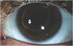 Figure 1. Fit of a hybrid lens on a normal eye can be evaluated without any sodium fluorescein despite the presence of a GP center.