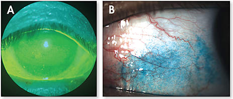 Figure 2. Severe sodium fluorescein staining of the cornea (A) and severe conjunctival staining (B). (A) Courtesy of Karen Lee, OD (B) Courtesy of Whitney Hauser, OD