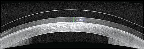 Figure 3. A patient who has oGvHD with complaints of fogging due to accumulation of debris in the scleral lens fluid reservoir observed with AS-OCT.