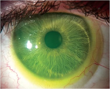 Figure 4. Excessive fluorescein pooling in the inferior limbal area.