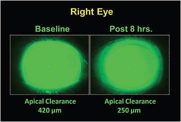 Figure 3. Fluorescein appearance upon scleral lens application and following eight hours of lens wear demonstrating little or no departure of tears from under the lens.